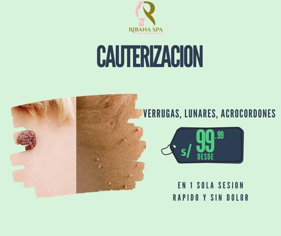 Cauterización Ribana Spa